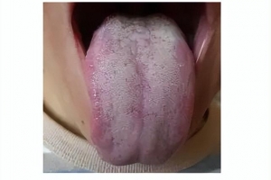 脾大吃什么药效果最好（脾大是什么原因引起的）