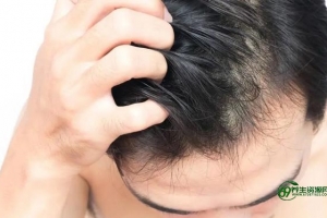 脂溢性脱发怎么治疗最彻底(女性脂溢性脱发怎么治疗)
