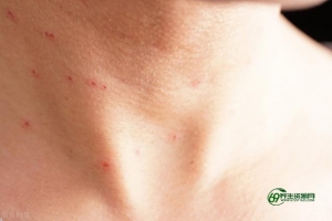 疣病毒怎么引起的（疣病毒能不能彻底治疗）