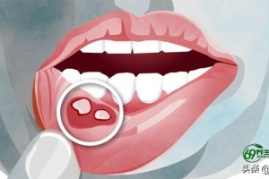 口腔溃疡是什么原因造成图片(经常口腔溃疡是什么原因造成)