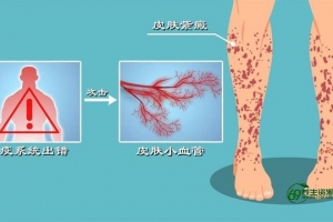 过敏性紫癜中医治疗还是西医治疗（过敏性紫癜中医治疗要多久）
