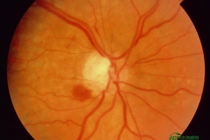 咽拭子采集的正确部位（咽拭子 鼻咽拭子）