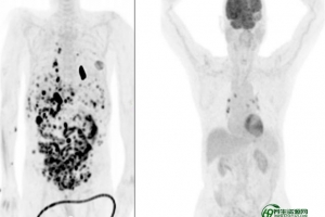 自体免疫细胞治疗(生物免疫细胞治疗)